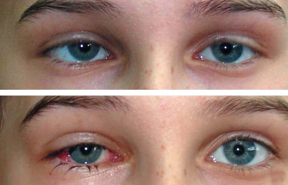 Pred a po liečbe Oculax